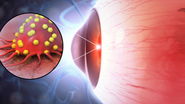 Заради прекомерна работа с компютър? Все повече хора развиват тумори вътре в очите си